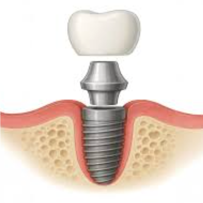 Dental Implants