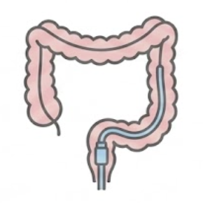 Painless Colonoscopy